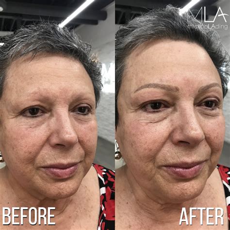 Video Eyebrow Microblading For Cancer Survivors And Frequently Asked