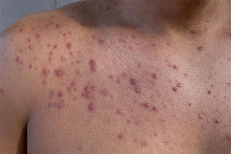 How To Get Rid Of Shoulder Acne Effective Solutions And Tips