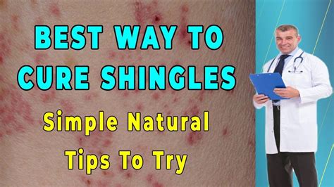 How To Treat Shingles Naturally Cleared Shingles Pain In Days Youtube