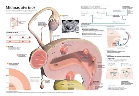 Miomas uterinos diagnóstico y tratamiento Clínica Universidad de Navarra