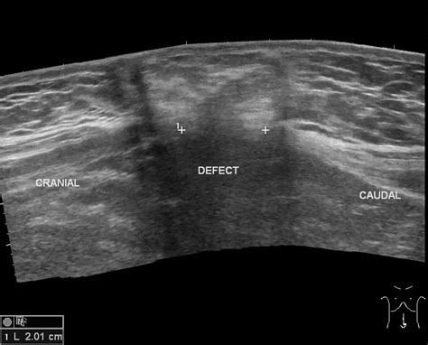 Umbilical Hernia Image