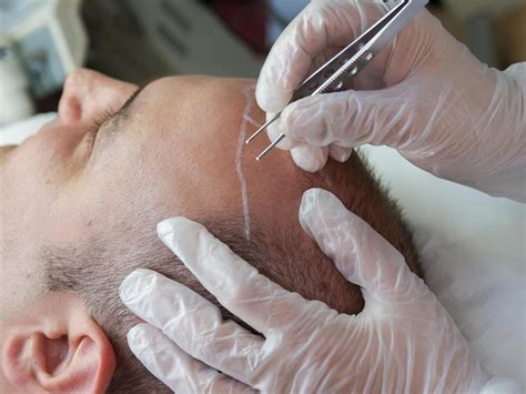 Man Dies After 12 Hour Hair Transplant The Independent The Independent