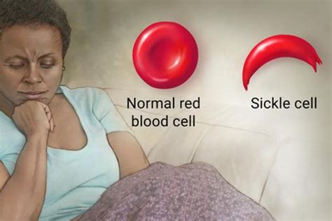 State Dropping M On Sickle Cell Care Helps Blacks Others Living