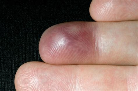 Bruised Finger Photograph By Dr P Marazziscience Photo Library