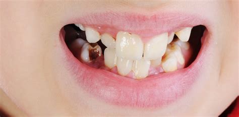 Tooth Decay Az Dentist