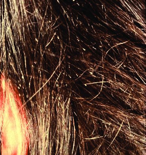 Nits On The Hair Of An Infested Child Female Lice Usually Lay Their