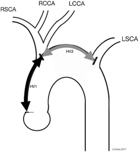 Illustration Of A Bovine Aortic Arch Branching Pattern And Distances