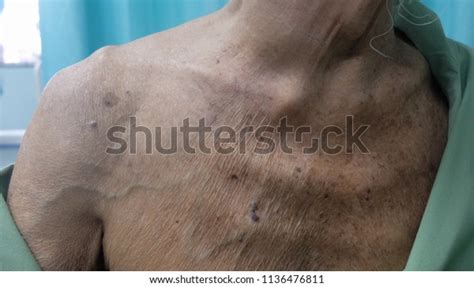 Dilated Superficial Veins Secondary Obstructed Superior Foto Stok