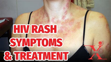 How To Identify Hiv Skin Rashes And How It Can Be Treated Youtube