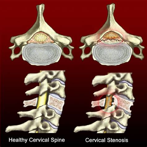A herniated disc is when the material inside the disc pushes outwards, irritating the nerve exiting at that level. What's Worse - Stenosis or a Herniated Disc? (Neck Pain ...