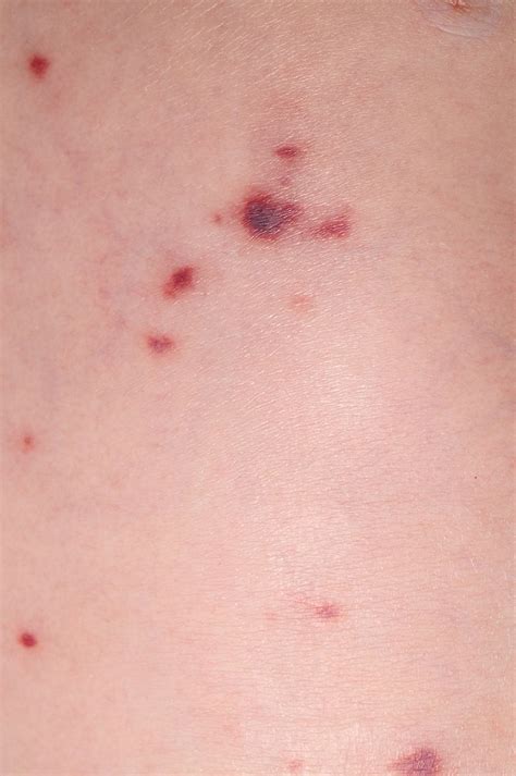 Purpuric And Petechial Rashes In Adults And Children Initial