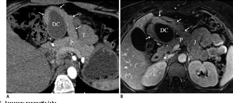 Figure 15 From Congenital Variants And Anomalies Of The Pancreas And