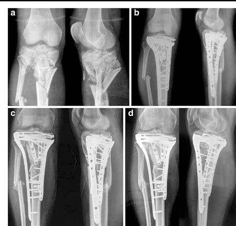 Tibial Fractures Images