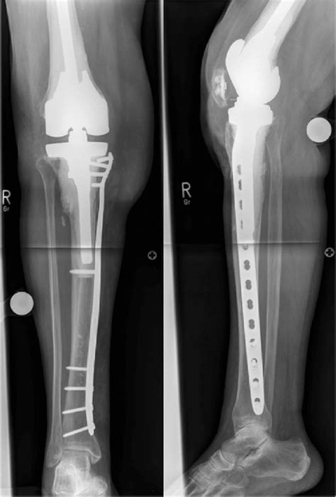 Orif With A Long Medial Plate In A Periprosthetic Tibial Fracture