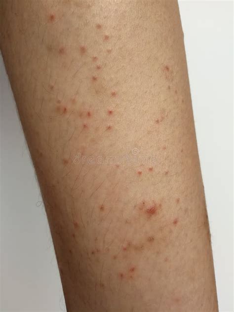 Infection Fongique Ou Dermatite Chronique Dans Labdomen De Lhomme