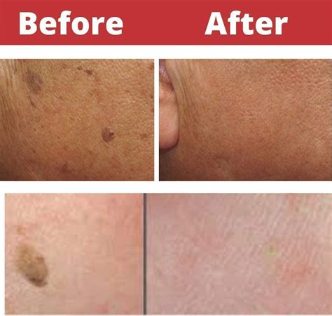 The Seborrheic Keratosis Removal Glycolic Acid Peel Solution The