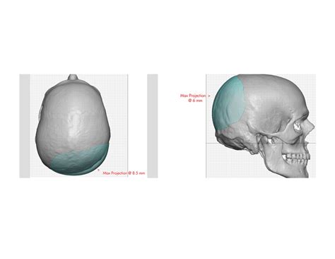 Plastic Surgery Case Study Custom Occipital Skull Implant For