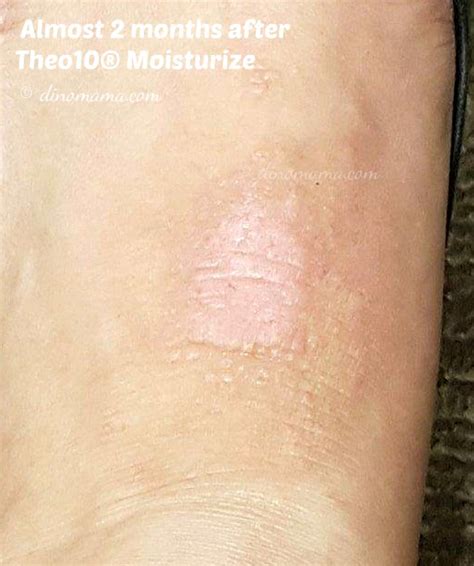 Keep Eczema Under Control With Theo10® Moisturiser And Eczema Cream