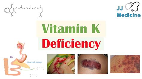 Check spelling or type a new query. Vitamin K Deficiency | Dietary Sources, Causes, Symptoms ...