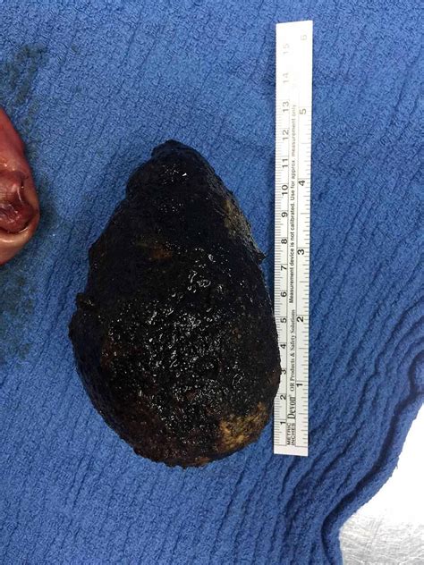 Cureus A Giant Gallstone The Largest Gallstone Removed