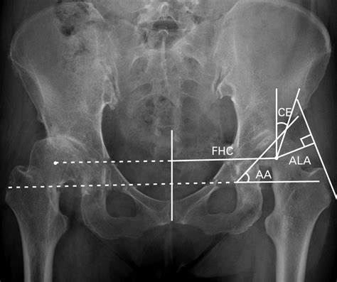 The Role Of Femoral Neck Anteversion In The Development Of