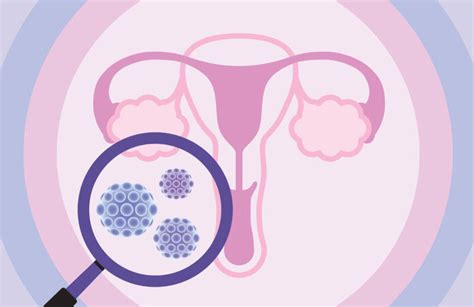 Hpv Testing And Genotyping For Cervical Cancer Screening Inside