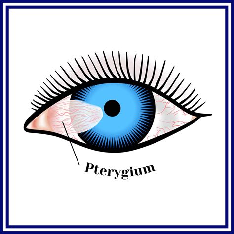 Eye Infections Contact Lens And Corneal Ulcer Lsc Eye Clinic