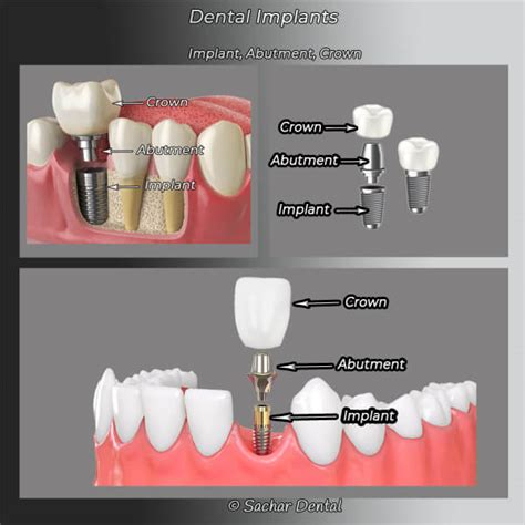 Dentist Nyc Dental Implants Manhattan Sachar Dental Nyc