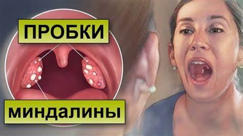 Диета при вырезанных гландах