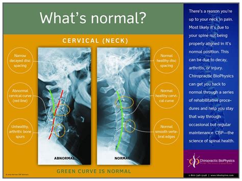 Normal Vs Abnormal Cervical X Ray Chiropractic Biophysics Spinal