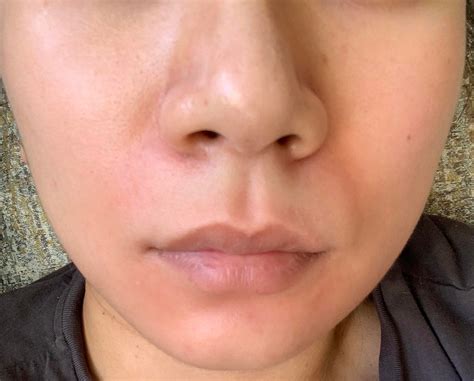 Help Redness Around My Nose And Mouth No Dry Textures Or Pustules