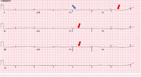 Electrocardiogram Showing Sinus Bradycardia Rate Of 41 Beatsminute