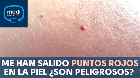 Síntesis De 30 Artículos Puntos Rojos En La Piel Como Sangre