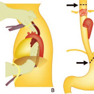 The procedure consists in an abdominal stage. Esophagocutaneous fistula in a 55-year-old man with SCC of ...