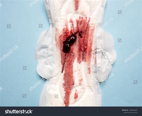 Symptom Endometriosis Menstrual Blood Blood Clots Stock Photo