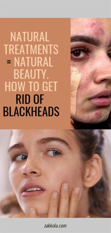 Home Remedies To Reduce Acne Redness Beauty And Makeup Tips Acne