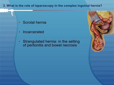 Laparoscopic Inguinal Hernia Repair Eminence Based Or Evidence Based