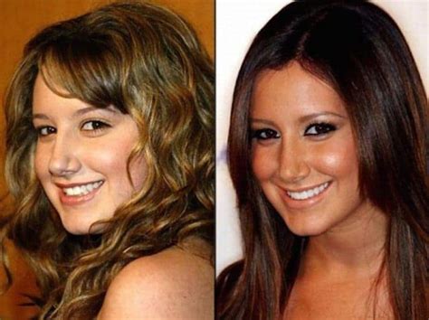 20 Celebrities Who Have Undergone Plastic Surgery