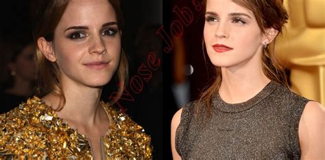 Did Emma Watson Had Nose Job Plastic Surgery Or Not