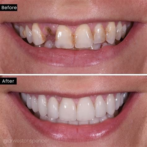 Dental Patient Gallery Before And After Photos Weston Spencer Dds