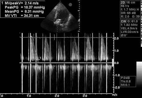 Transthoracic Echocardiogram At The Level Of The Starredwards Mitral
