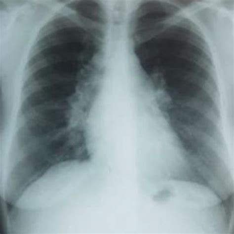 Chest Radiography Enlarged Mediastinum With Bilateral Paratracheal And
