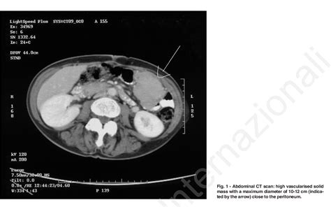 Figure 1 From A Case Of Extraovarian Primary Peritoneal Carcinoma In An