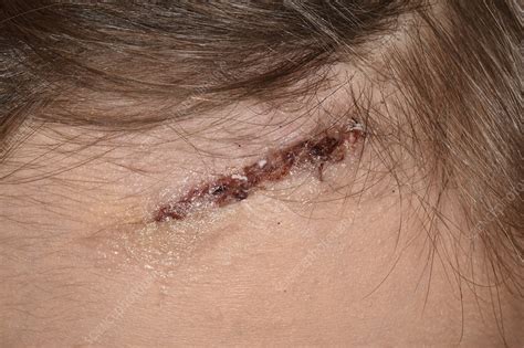 Laceration To Forehead Stock Image C0473034 Science Photo Library