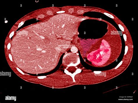 Axial Computed Tomography Ct Scan Of The Abdomen Showing A Stock
