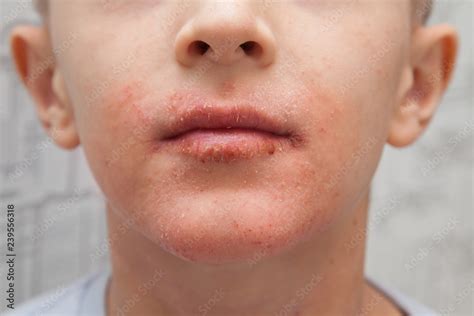 Allergic Reaction On Lips Pictures