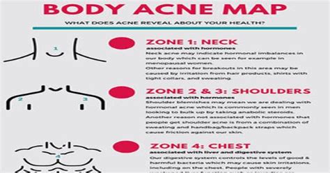 Acne Body Map What Does Acne Reveal About Your Health Infographic