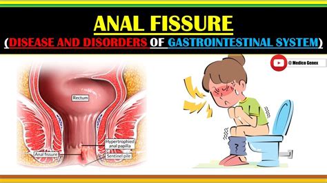 Anal Fissure Causes Of Anal Fissure Sign Of Anal Fissure Management Of Anal Fissure Mg