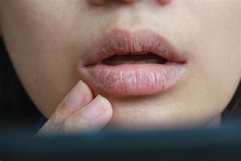 8 Natural Remedies To Get Rid Of Cracked Lips Womens Alphabet