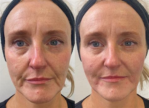 Fillers Before And After Fillers For Face Before And After Dermal
